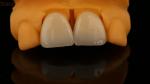 5 Year Guarantee Full Contour Zirconia Crown Customized Vita Shade High