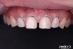 Real Looking Dental Porcelain Veneers Perfectly Fit Ceramic Teeth Veneers For