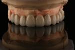 PFM Porcelain Fused to Metal Crowns and Bridges Seamless Bonding for Natural