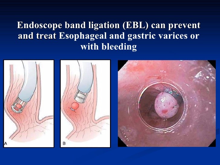Endoscopic Rubber Band Ligator 10mm Endoscopy Accessory