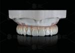 Translucent Full Contour Zirconia Bridge Over Milled Implant Bar Customized
