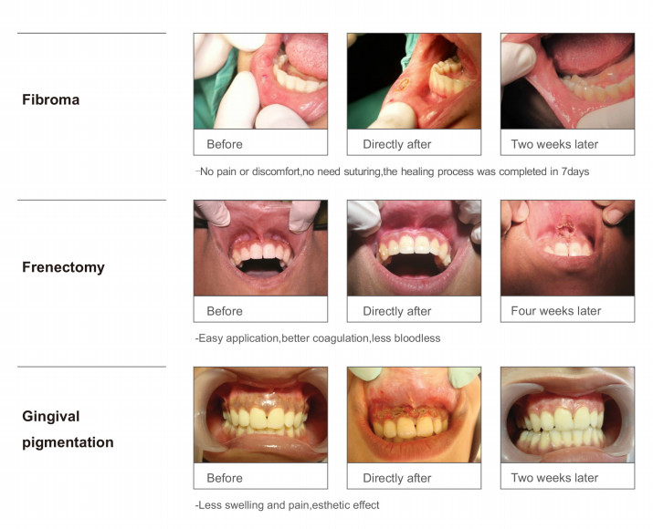 3 Wavelength Medical Diode Laser In Dentistry 450nm 650nm 980nm CE