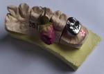 Full Cast Base Metal Alloys Dental Crown