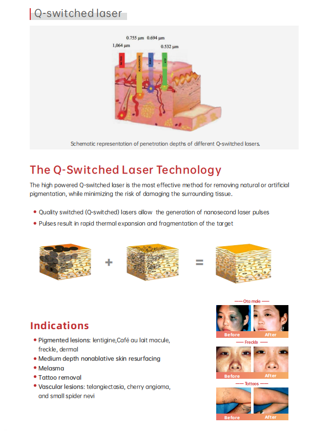 2021Nest q switched nd yag laser nd yag laser price 2 years warranty nd yag laser machine