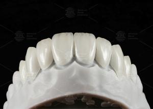 Quality Natural Pressed EMAX Veneer Strength 16 Shades Emax Teeth Veneers wholesale