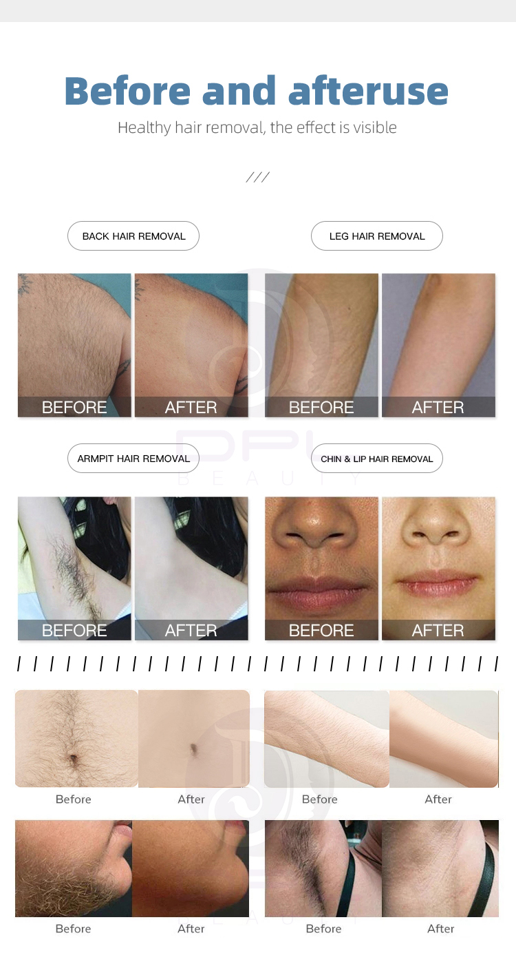 2 In 1 Diode Laser Hair Removal And Picosecond Laser Tattoo Remove Beauty Machine