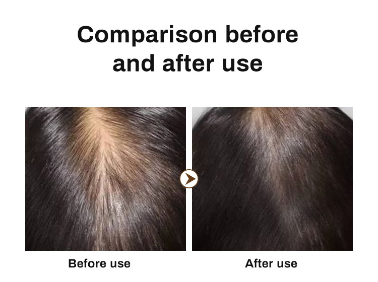 Best Selling Hair Growth Shampoo for Thinning Hair Loss for Women and Men Thicker Longer Hair