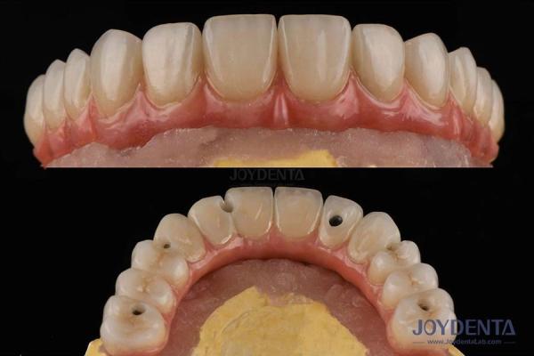 Rough Surface Dental Teeth Implant Platform Dental Bridges With Internal