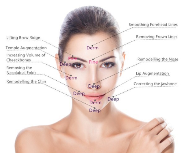 Fosyderm Dermal Filler Cross Linked Hyaluronic Acid Gel Lips Injection 24mg/Ml For Hyaluron Pen