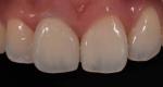 Inlays Onlays Ceramic Dental Crown Strong Veneer For Dental Department