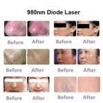 High Frequency Spider Veins Removal Machine 5Hz Relieves Redness CE