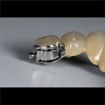 Aesthetic Precision Dental Implant Ball Attachment Partial Dentures