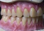 Hot Cured Full Arch Removable Acrylic Full Denture
