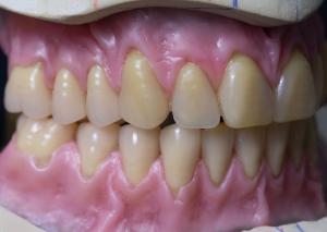 Quality Hot Cured Full Arch Removable Acrylic Full Denture wholesale