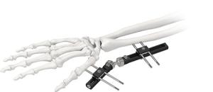 Quality Orthopedic Wrist External Fixator Standard Single sided Integrated wholesale
