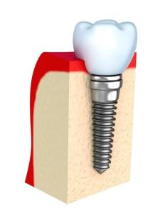 Quality Dentures Temporary Dental Implant Bar Single All Ceramic Teeth wholesale