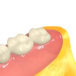Dental 3D Printing Invisible Denture Base Resin