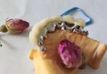 Metal Framework PFM Dental Crown