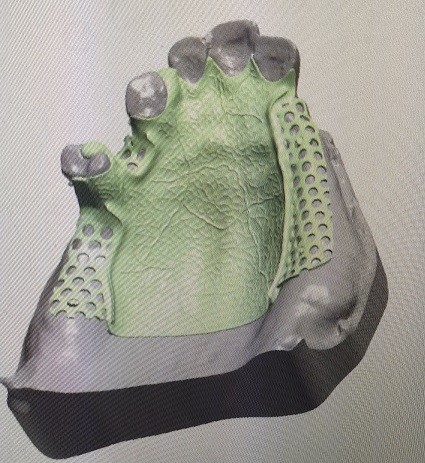 Removable 3D Printed Partial Denture Metal Framework