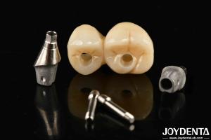 Quality Customizable Porcelain Dental Implant Supported Bridge And Crown For Exceptional Aesthetics wholesale