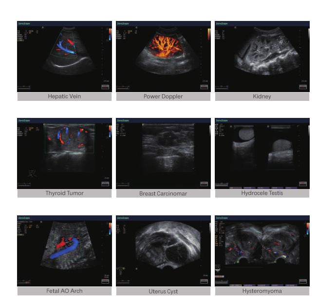 CW TDI software Sonoscape cardiac color doppler Sonoscape E2 E3 ultrasound