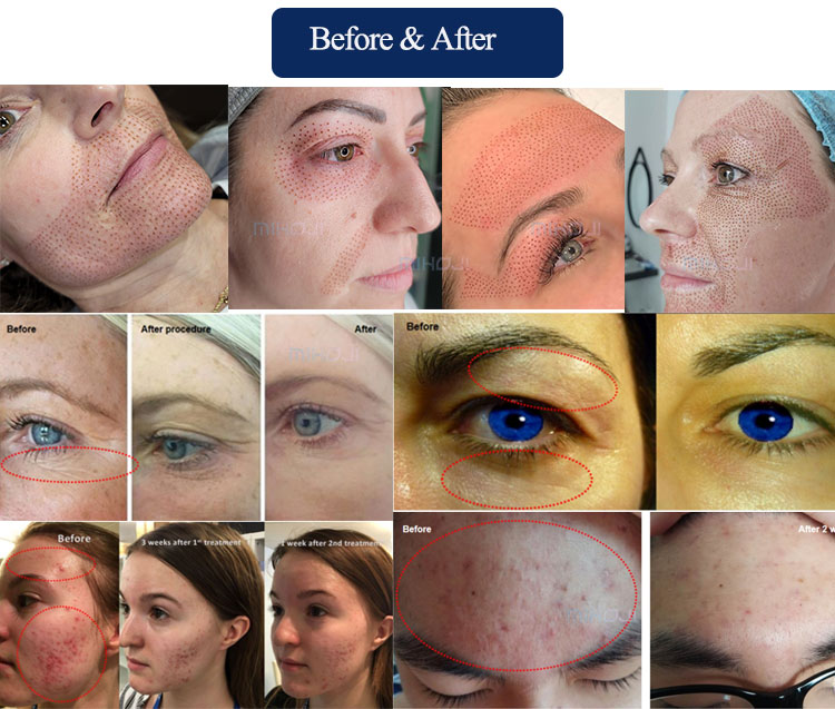Antibacterial Fractional Plasma Machine Customizable For Spot Removal