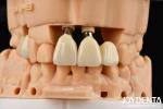 Close Friends Of Bones Foundation Of Beauty Zirconia Implants Aesthetic