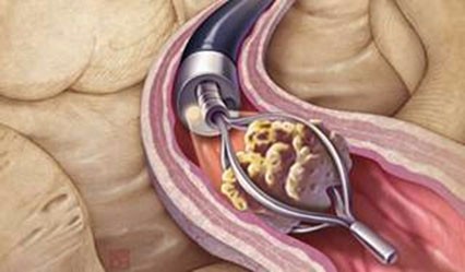 Disposable Endoscopic Stone Retrieval basket for foreign body removing
