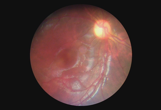 Handheld Digital Fundus Camera With True 5MP Image Resolution And 45° FOV Support 2G to 32G Files Storge