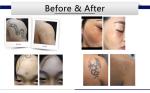 Nd Yag Pico Laser Tattoo Removal , Laser Resurfacing Machines 1064nm