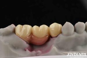 Quality Customizable Dental Implant Supported Bridge And Crown For Dental Implants wholesale
