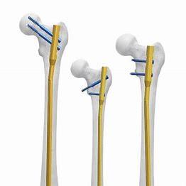 Quality CE 11mm Intramedullary Plate Antibiotic Nail Femur wholesale