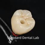 Screw Retained Dental Implant Crown