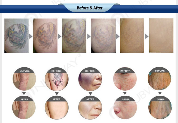 Professional q switched nd yag laser/painless 1064/532nm laser tattoo removal machine
