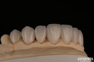 Quality Feldspathic Natural Looking Cosmetic Veneers Precise Fit Highly Translucent wholesale