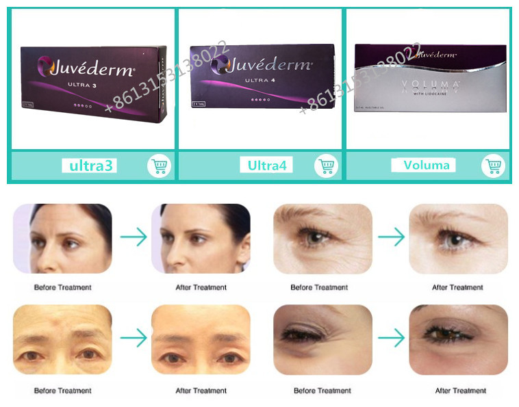 Injectable HA Juvederm Voluma Lip Filler Cross Linked Hyaluronic Acid Syringes