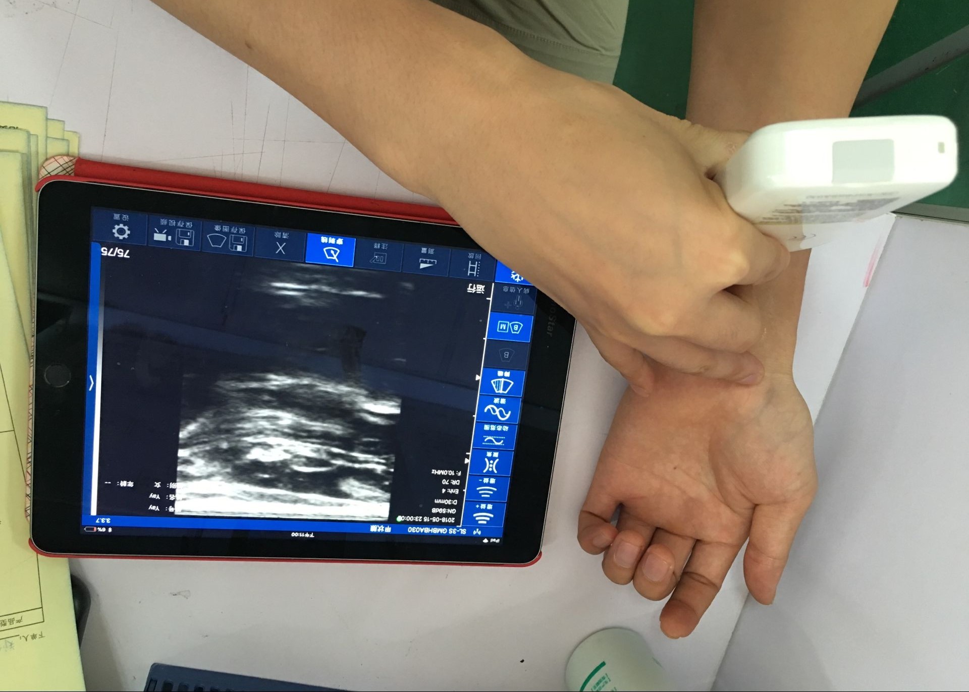 Small and Light Advanced Digital Imaging Wireless Linear Ultrasound