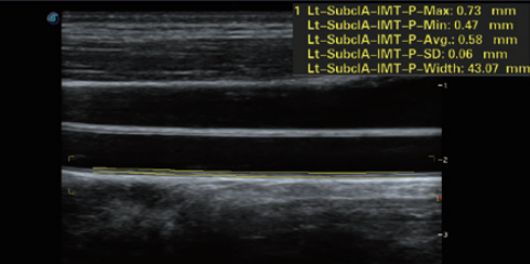 New design cardiac and 4d function Sonoscape P15 ultrasound for hospital