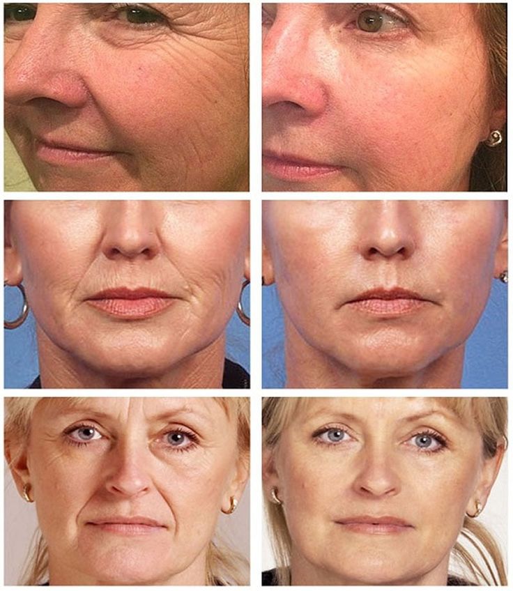 40w 60W Fractional CO2 Laser Machine For Wrinkle Removal Stretch Mark Scar Removal Tightening