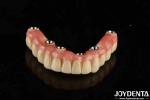 Dental Titanium Malo Implant Bridge Combining Traditional And Modern Techniques