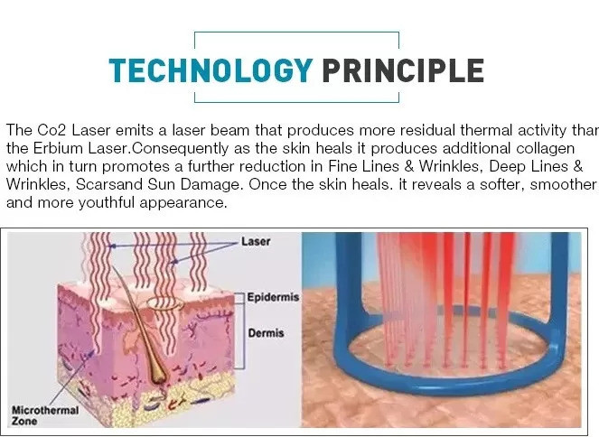 Continuous Interval Ultra Pulse RF Fractional CO2 Laser For Fractional Skin Resurfacing