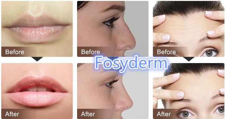 Clinic Injectable Dermal Filler , Transparent Hyaluronic Acid Injection