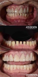 Quality Nature Shape Cosmetic Dentistry Porcelain Veneers , Dental Cosmetic Porcelain Veneers wholesale