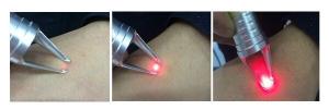 Quality Professinal skin tag removal 980 diode vascular laser machine diode laser 980nm wholesale