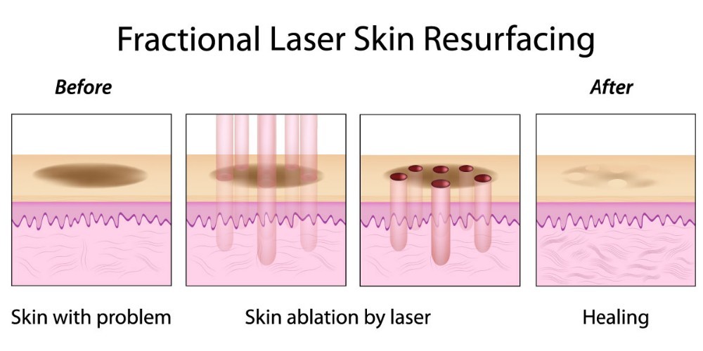 CO2 Fractional Laser Scar Removal Machine For Skin Repair Clinics With High Power Energy Output And Cooling System
