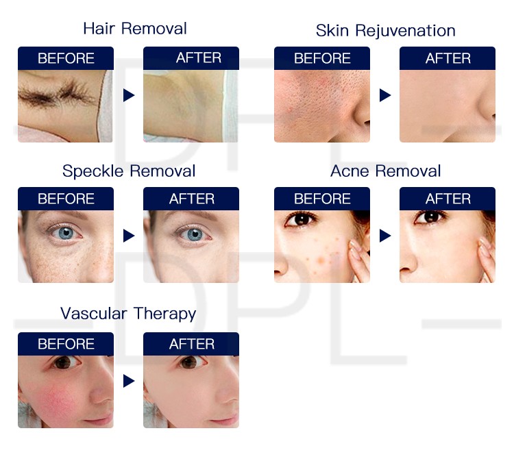 CE Approved Facial Equipment Intense Pulse Light OPT IPL Laser Hair Removal Device