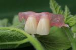 Flexible Invisible Denture