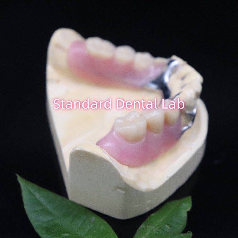 Acrylic Metal Partial Denture Frameworks High Esthetics SDL dental lab