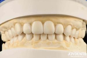 Quality Dental Biomimetic Aesthetic Diagnostic Wax-Up Of Veneers wholesale