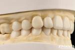 Dental Biomimetic Aesthetic Diagnostic Wax-Up Of Veneers